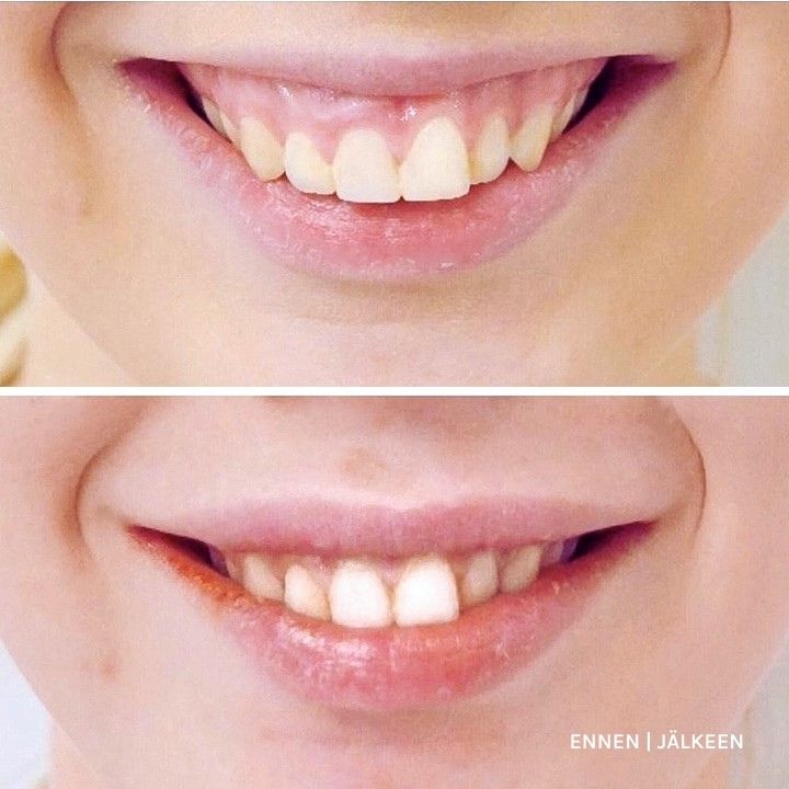 Botox gummy smile ennen jälkeen – ienhymyn korjaus botuliinihoidolla