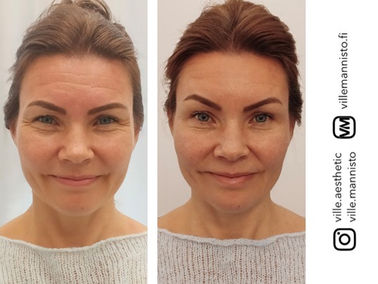 botox otsa ennen jälkeen luonnollinen lopputulos