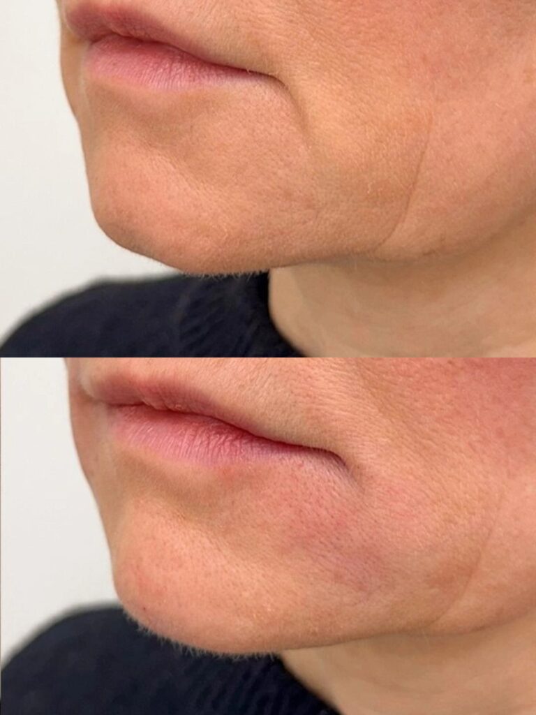 Botox for the corners of the mouth