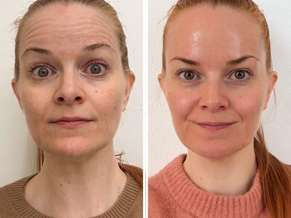 Botox – kattava opas botuliinihoitoon