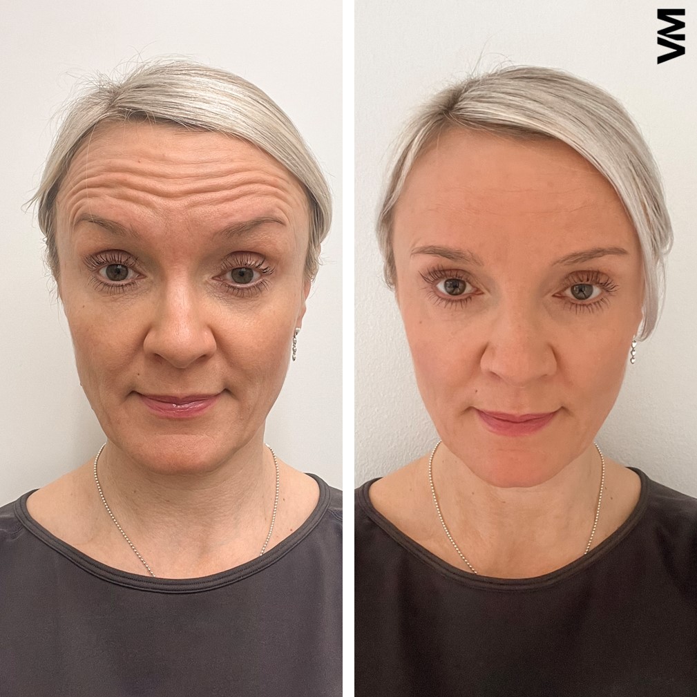 otsan vaakajuonteiden botox hoito ennen jälkeen Helsinki Ville Männistö