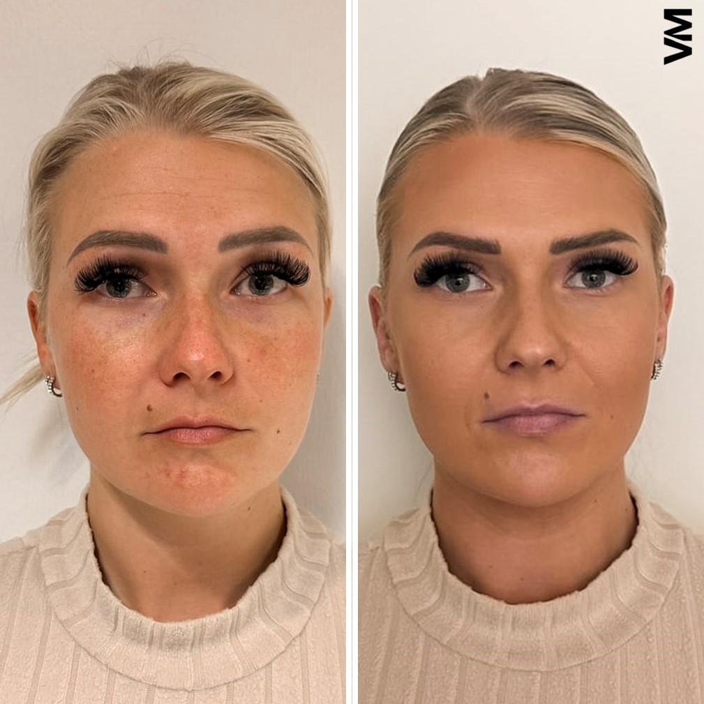 Botox | Botuliinihoito | Kirurgi Ville Männistö