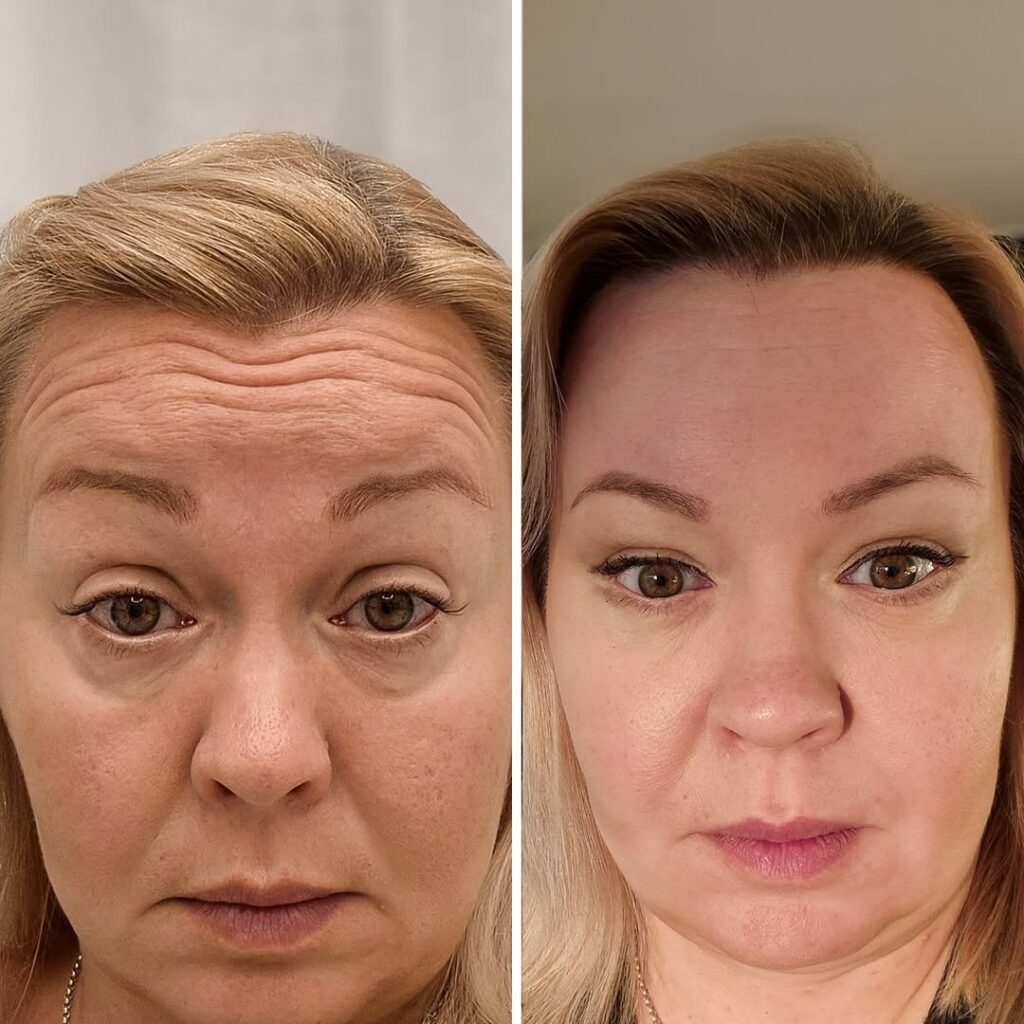botox pori ville männistö