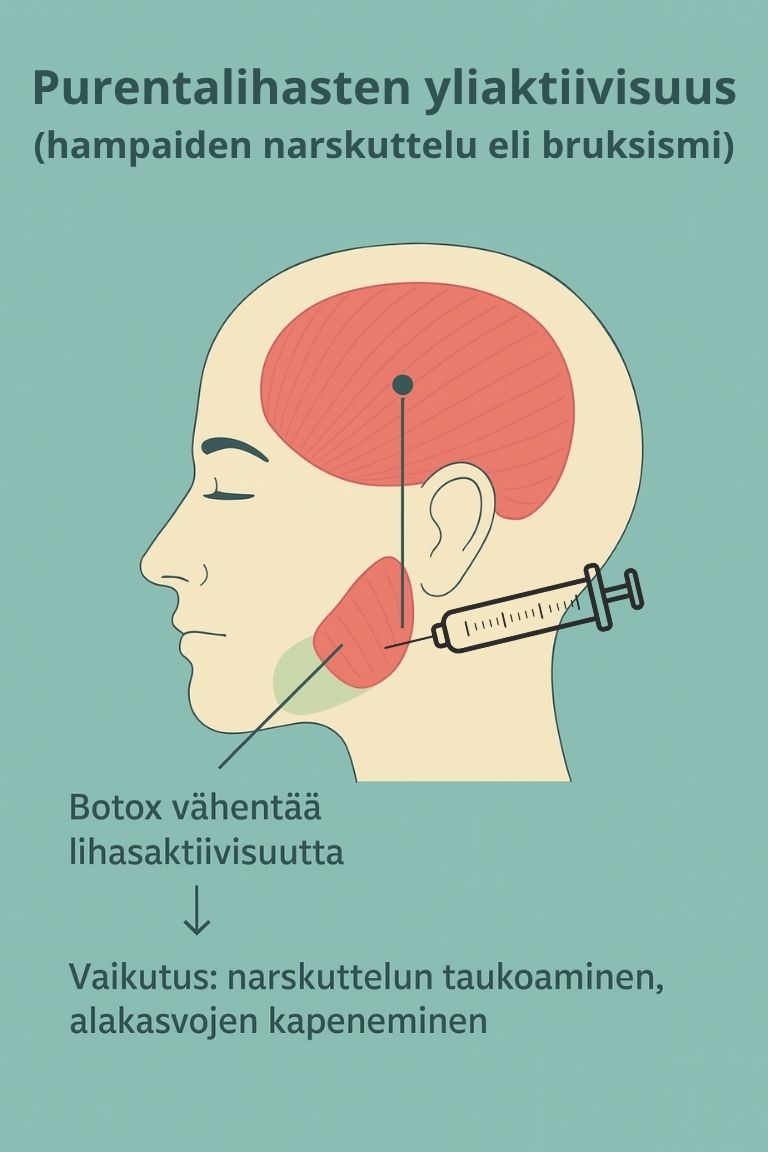 botuliinihoito purentalihakset masseter temporalis bruksismi