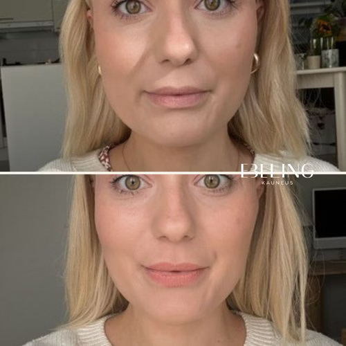 bruksismi botox masseter ennen jälkeen purentalihakset