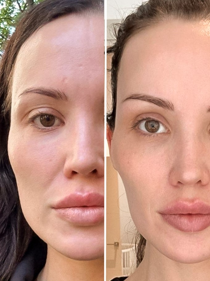 Bruksismi botox ennen jälkeen – purentalihaksen hoitotulos