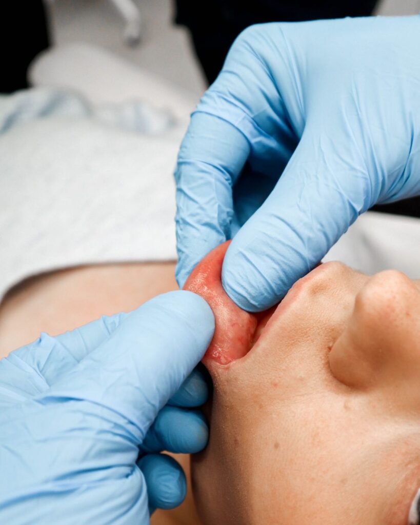 Kirurgi tutkii huulten aluetta ennen täyteaineen poistoa