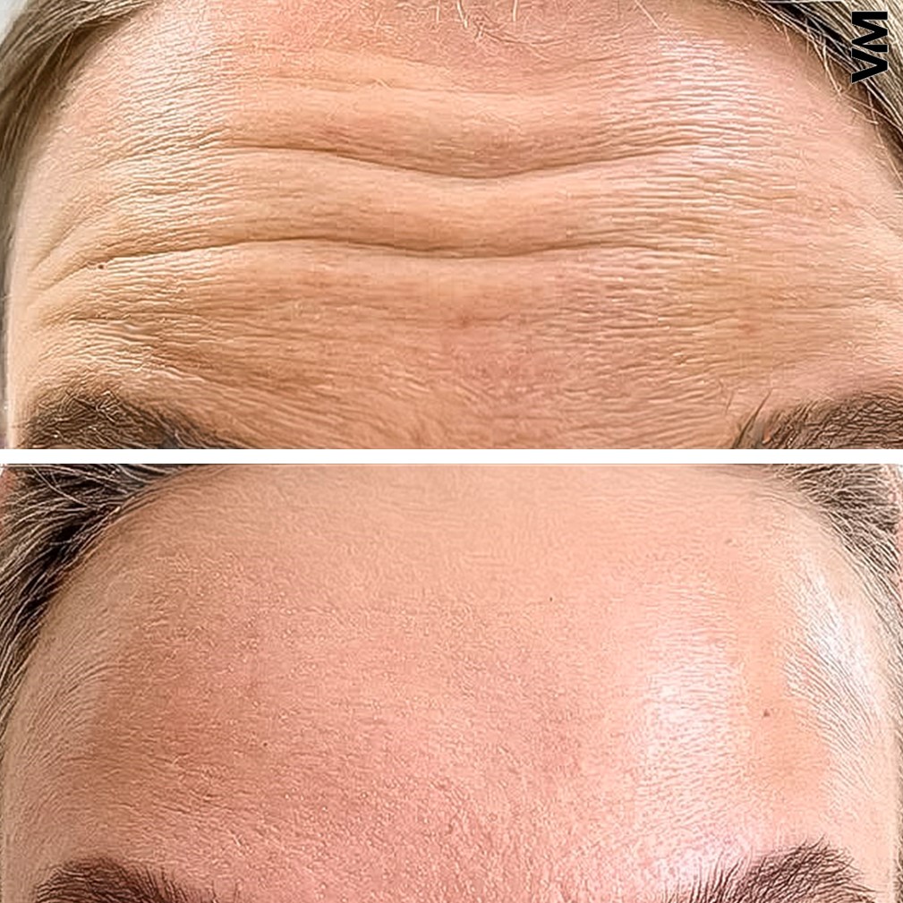 botox helsinki botox otsaan