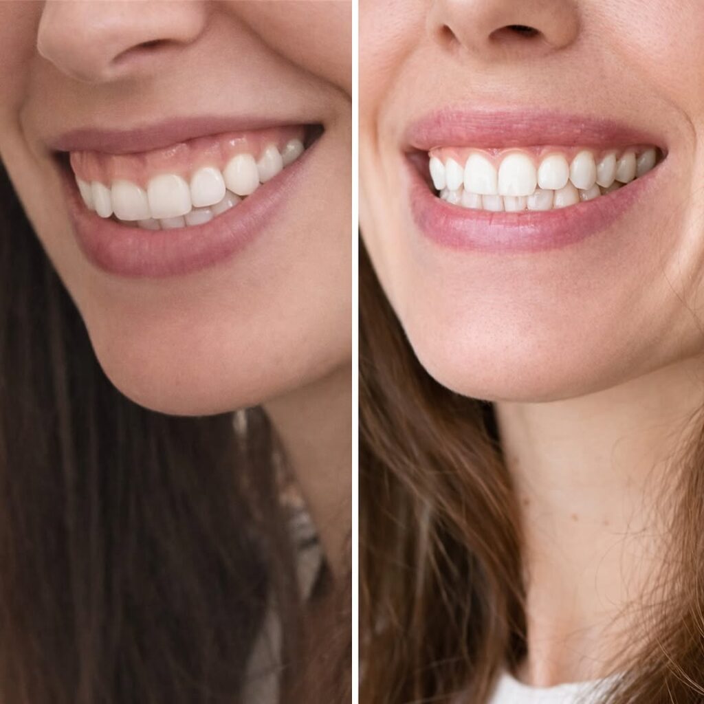 botox lip flip sekä ienhymyn hoito Helsingissä ennen ja jälkeen