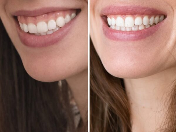 Botox lip flip – miten hoito toimii?