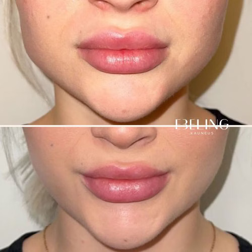 masseter botox ennen jälkeen purentalihas kasvojen kavennus