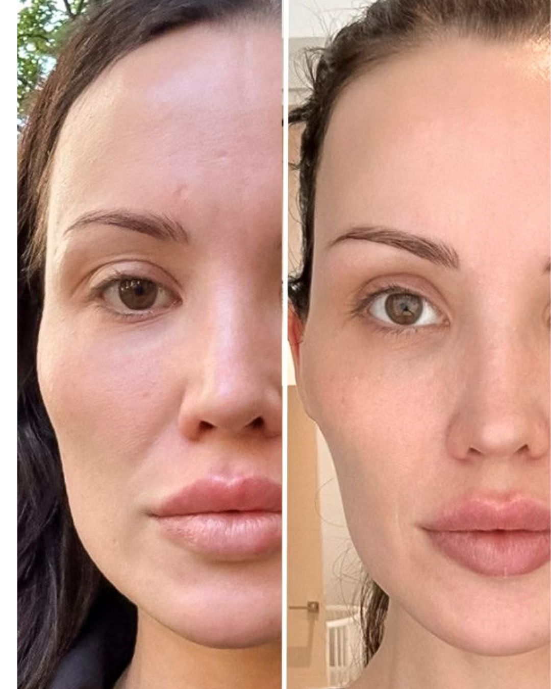 Masseter botox hinta 549 €