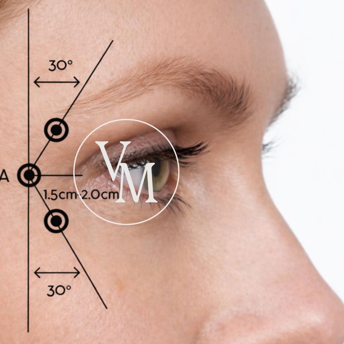 botox crow's feet pistoskohdat orbicularis oculi