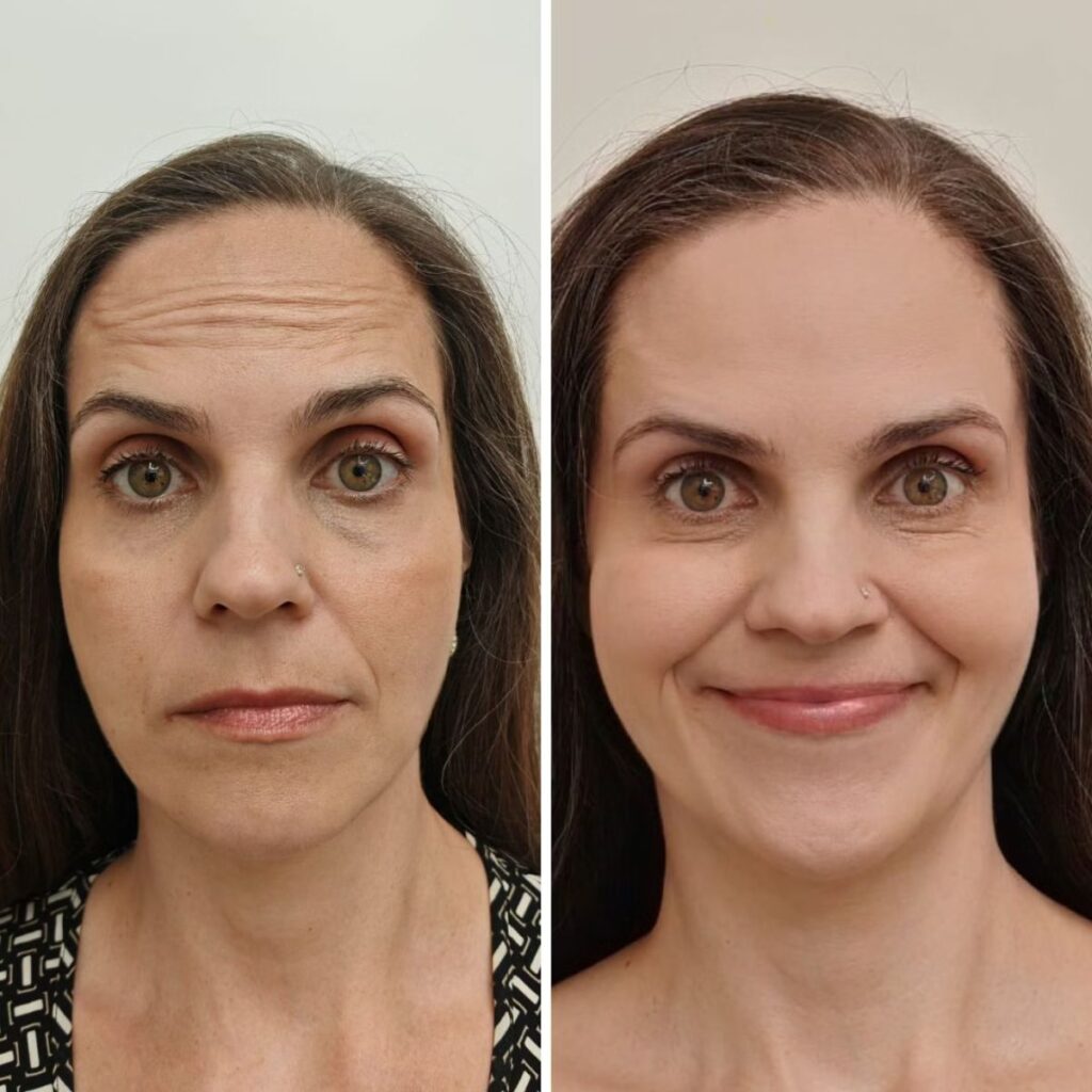 botox riskit haittavaikutukset