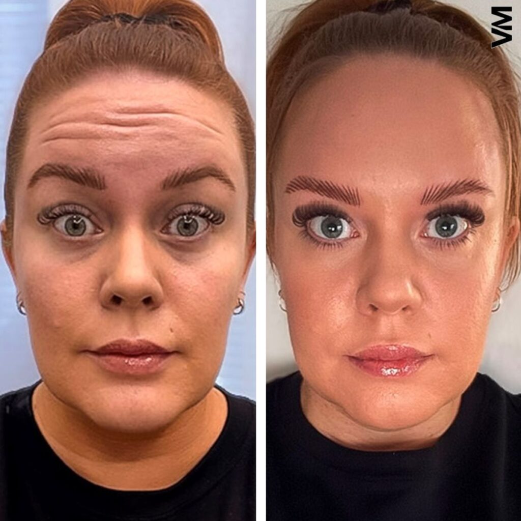 botox otsa ennen jälkeen