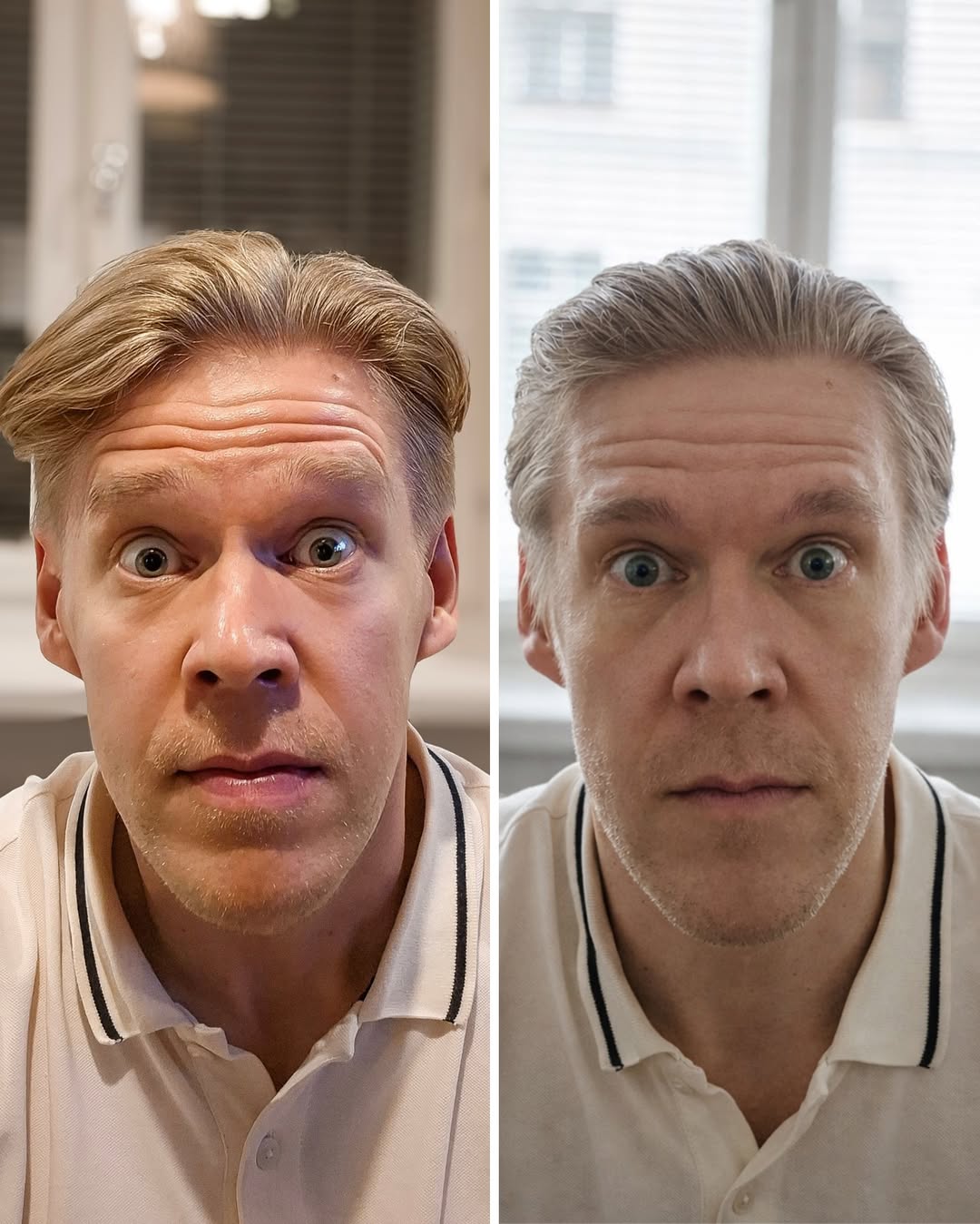 botox mies ennen jälkeen otsa sibelius luonnollinen lopputulos