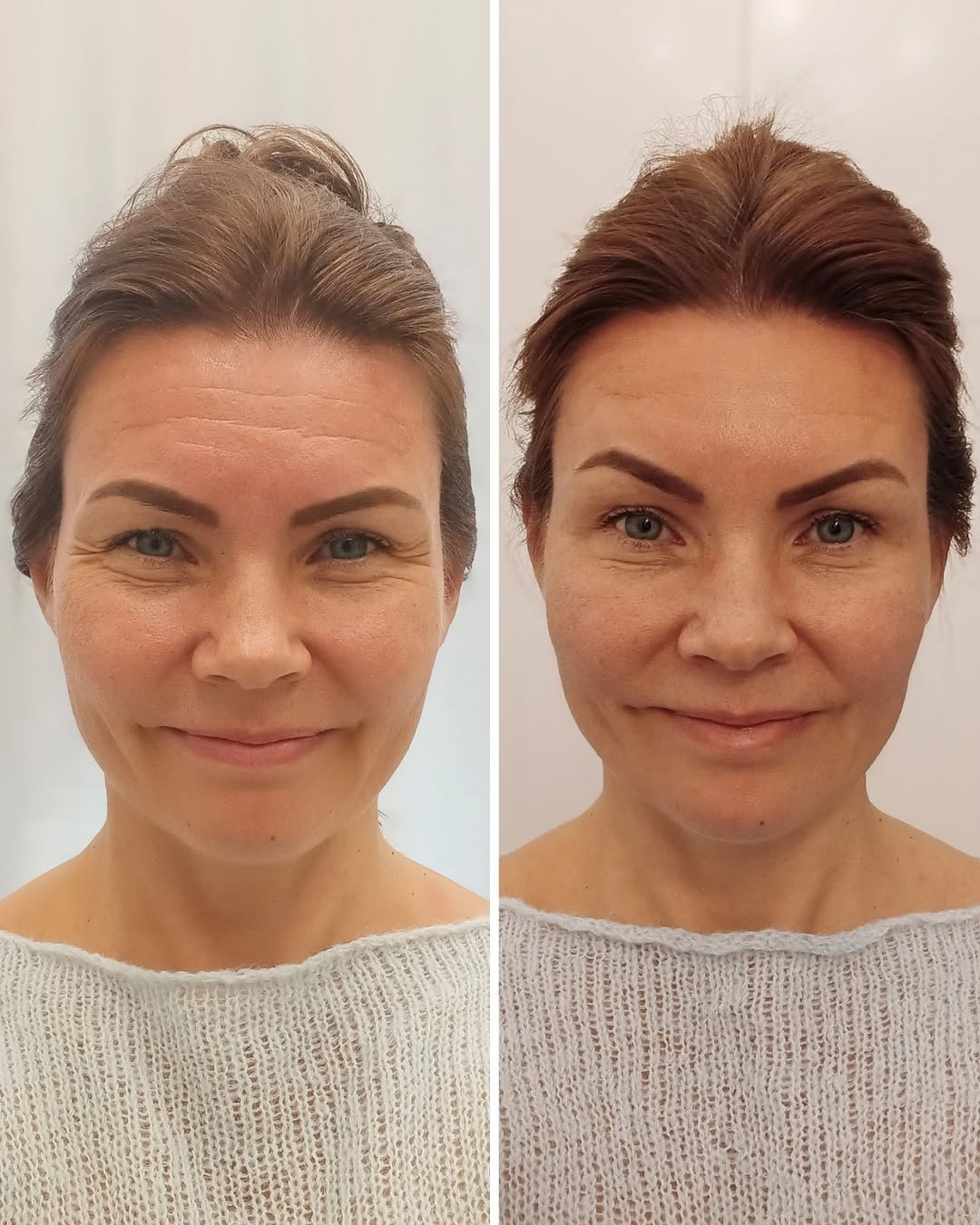 Botox otsa ennen jälkeen – otsan juonteiden hoitotulos