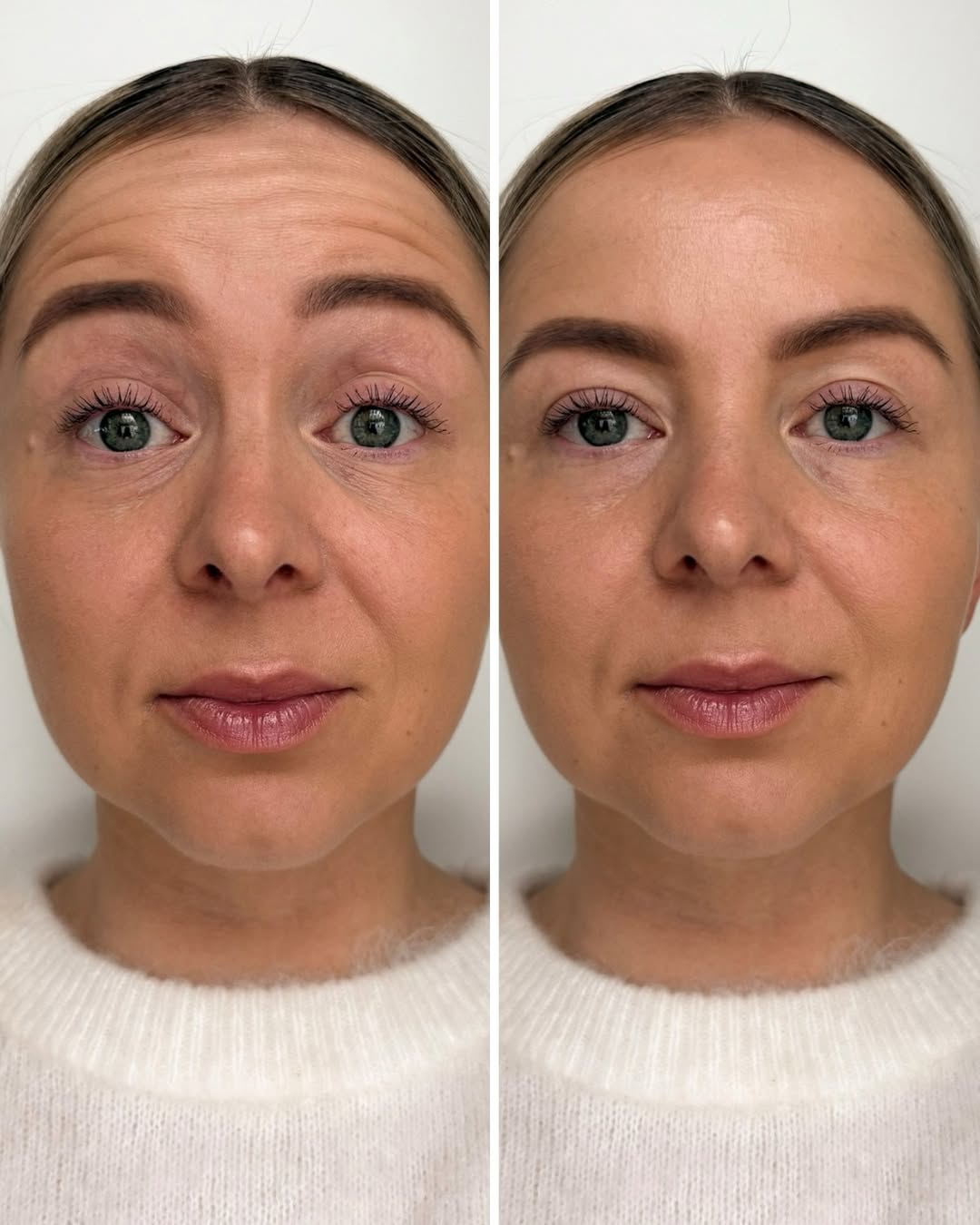 Otsan botox ennen jälkeen – otsan ryppyjen hoitotulos