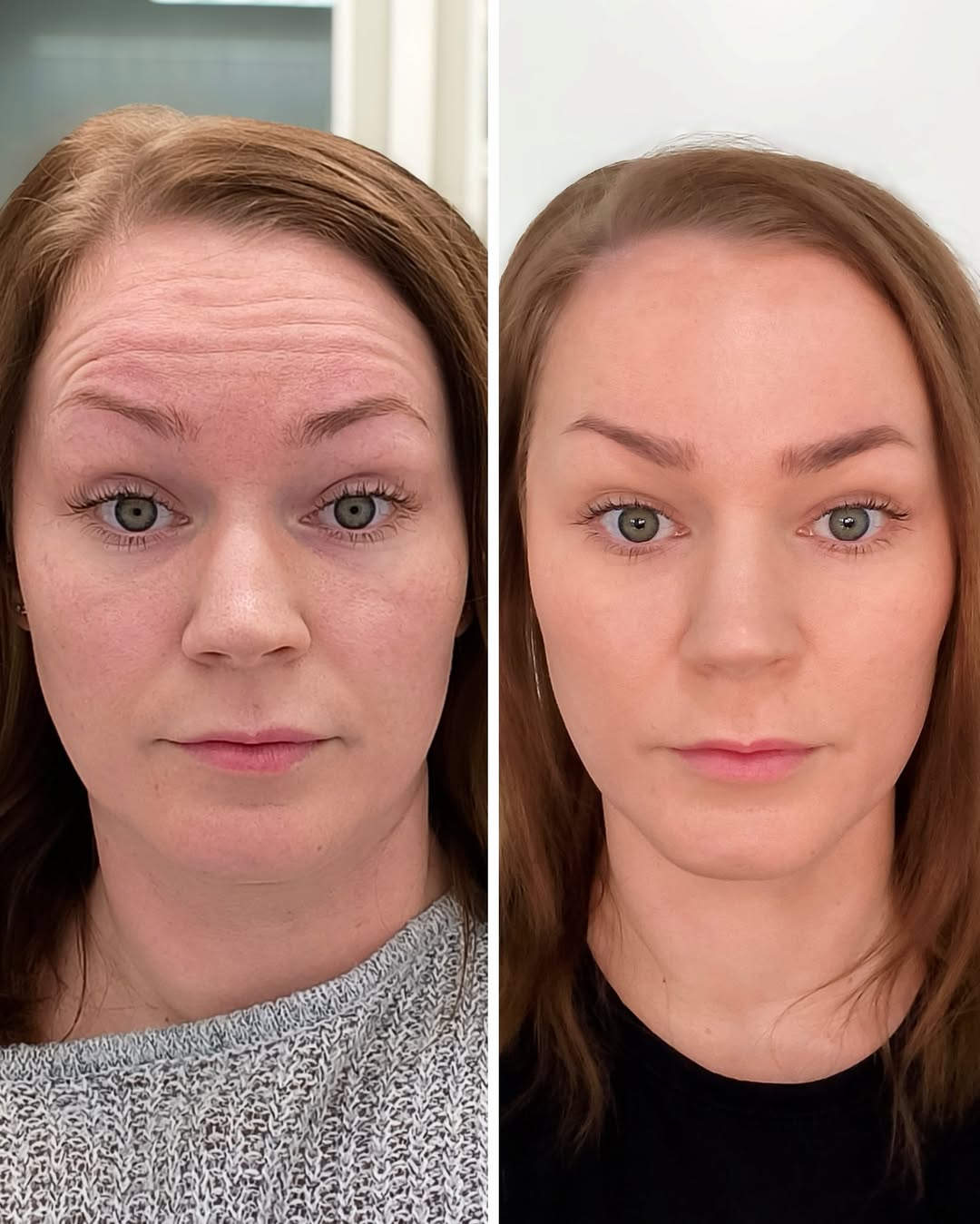 Botox otsan juonteisiin ennen jälkeen
