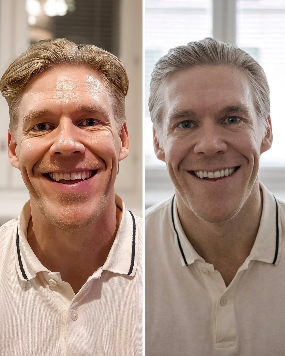 Botox otsa ennen jälkeen miehelle – otsan juonteiden hoitotulos