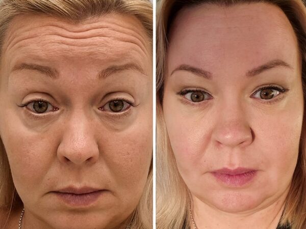 Botox before and after – genuine treatment results