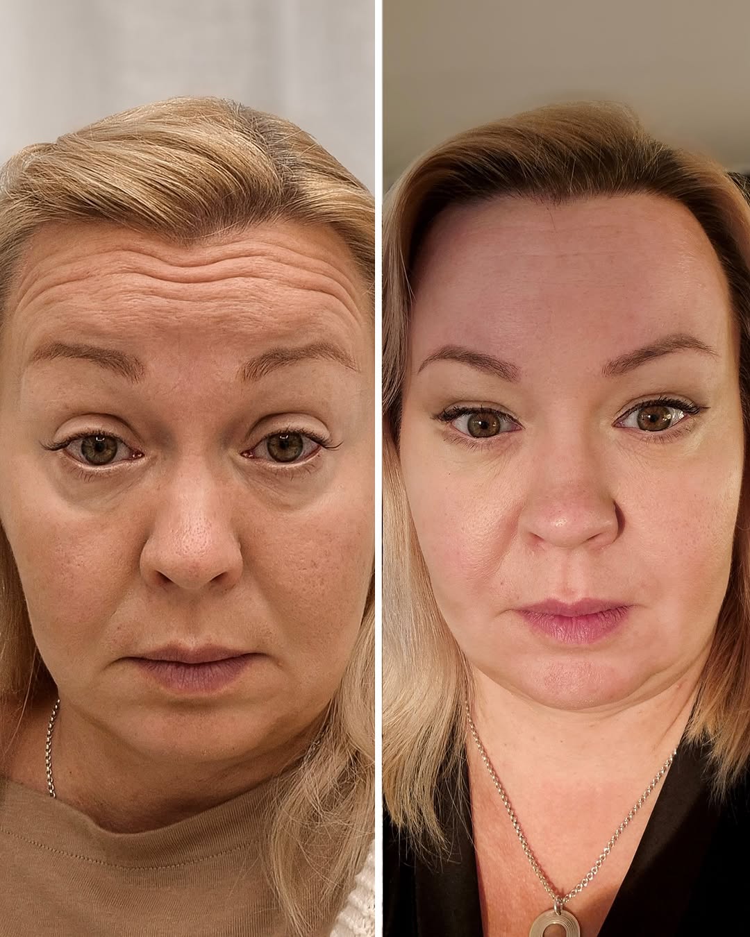 Botox otsa ennen jälkeen – otsan vaakajuonteiden hoitotulos