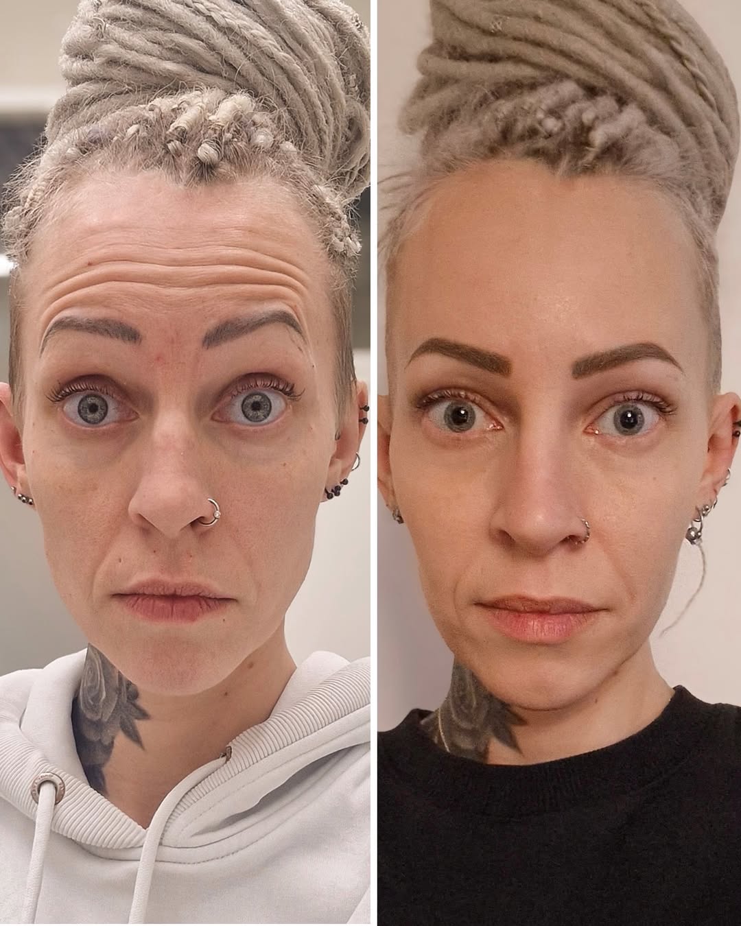 Otsarypyt ennen ja jälkeen botox-hoidon