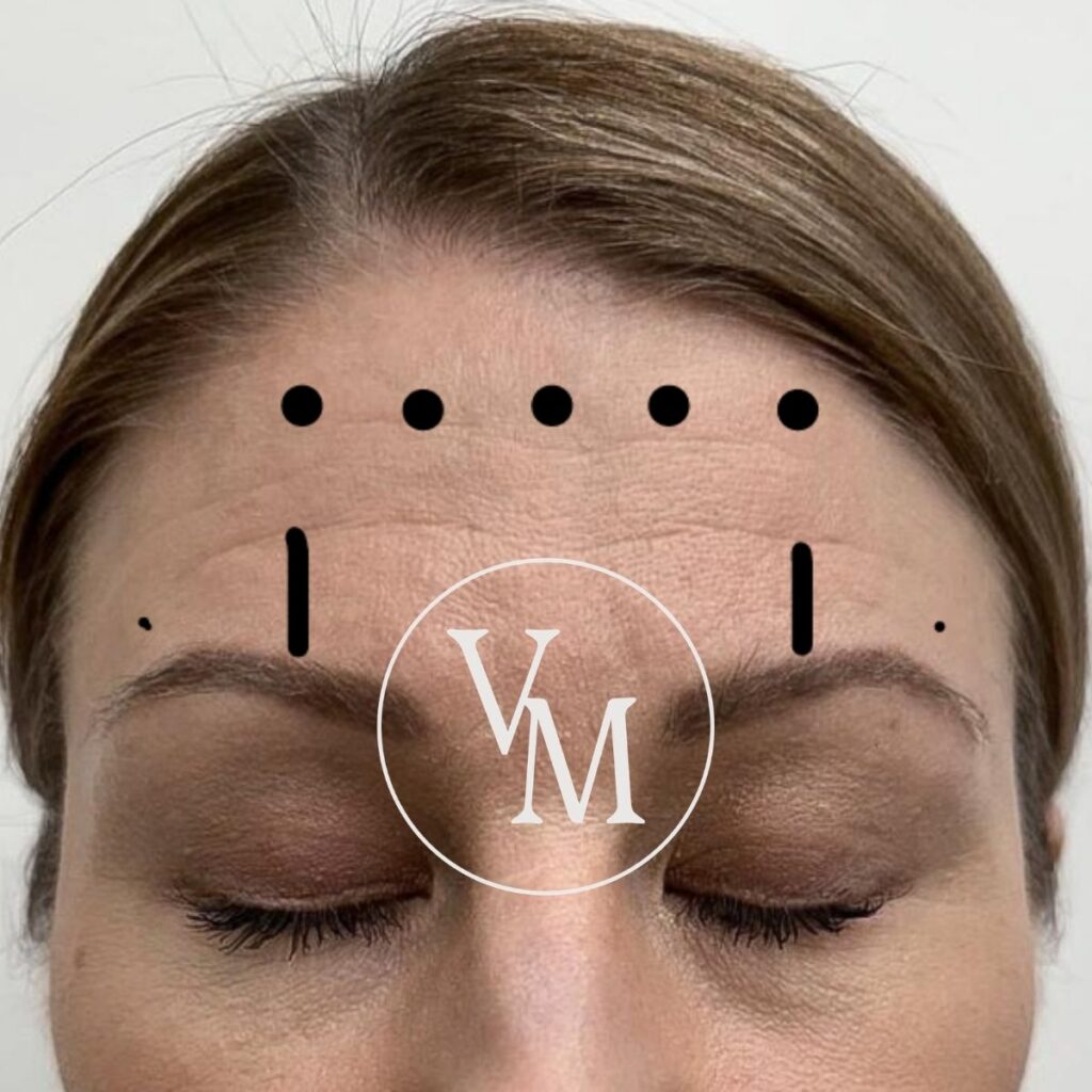 botox otsa pistoskohdat frontalis lihas otsarypyt