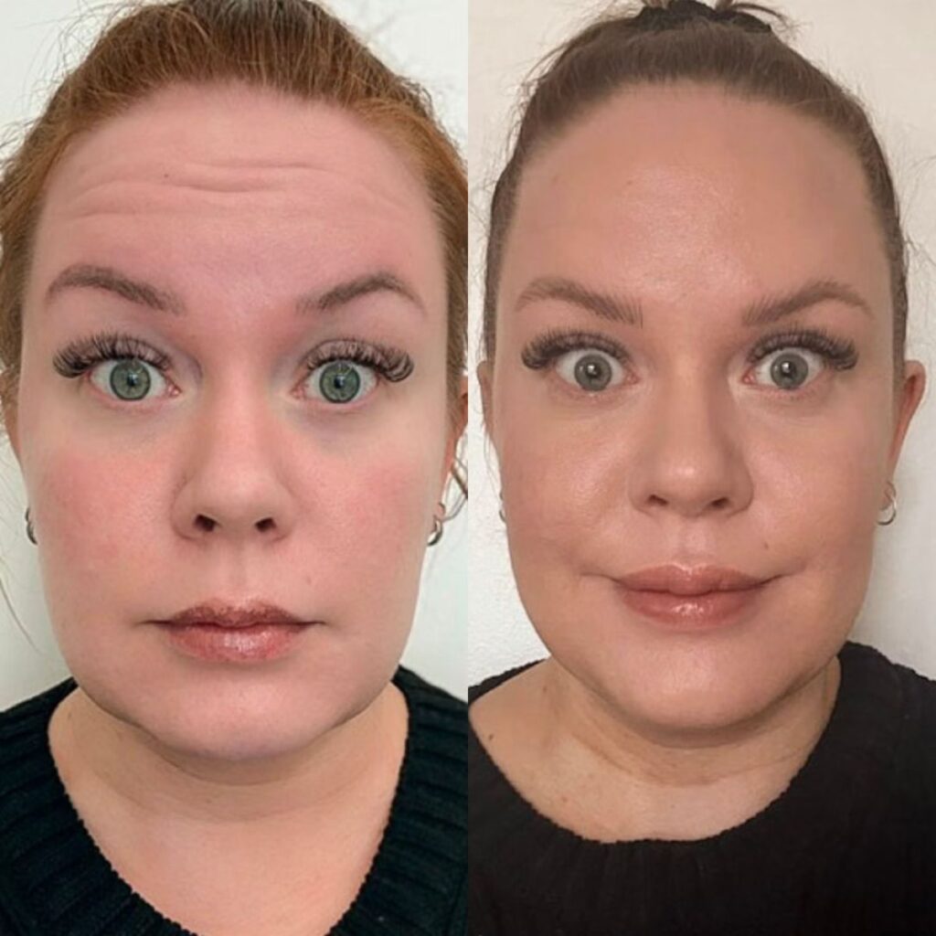 botox otsaan ennen jälkeen