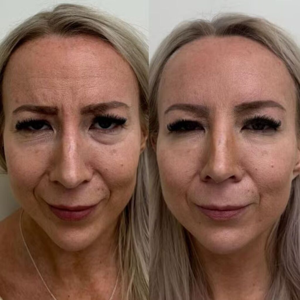 botox otsa ennen jälkeen