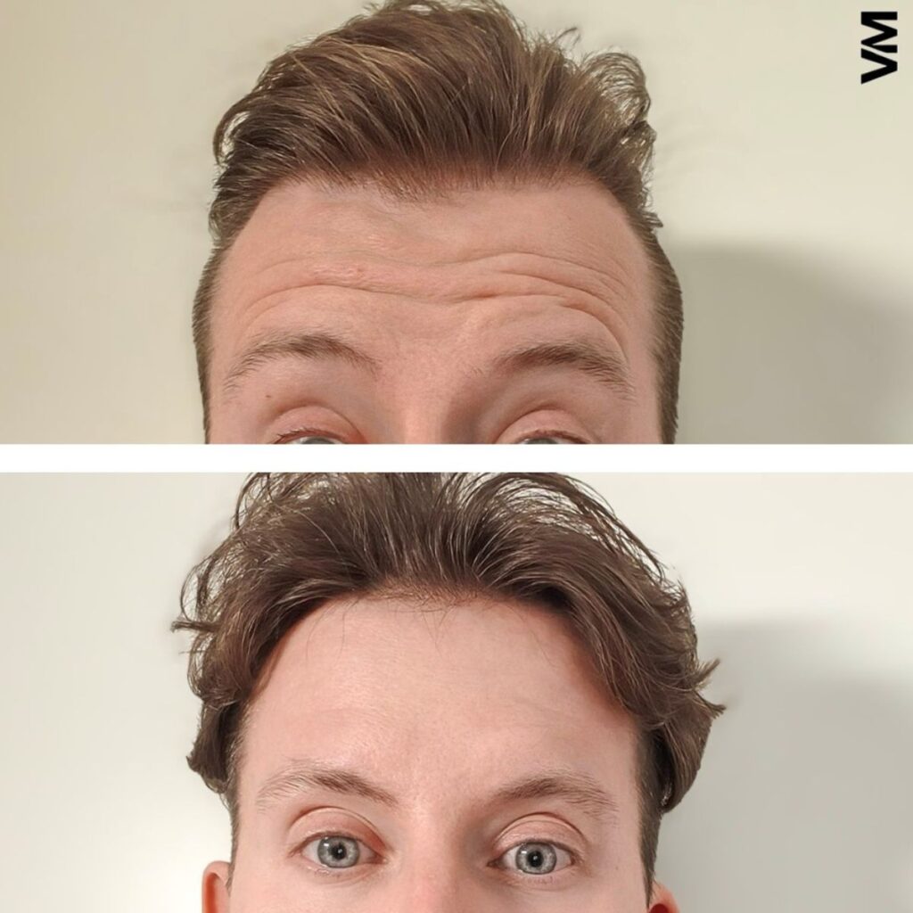 botox otsa ennen jälkeen pori