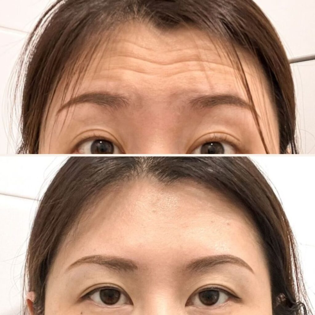 botox otsaan helsinki ennen jälkeen