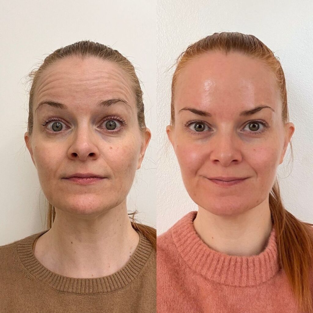 botox otsaan ennen jälkeen pori