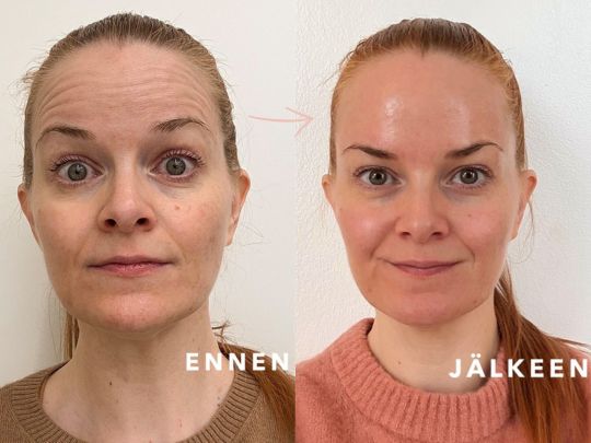 botox otsarypyt ennen jälkeen Tampere Ville Männistö otsan vaakaryppyjen botuliinihoito