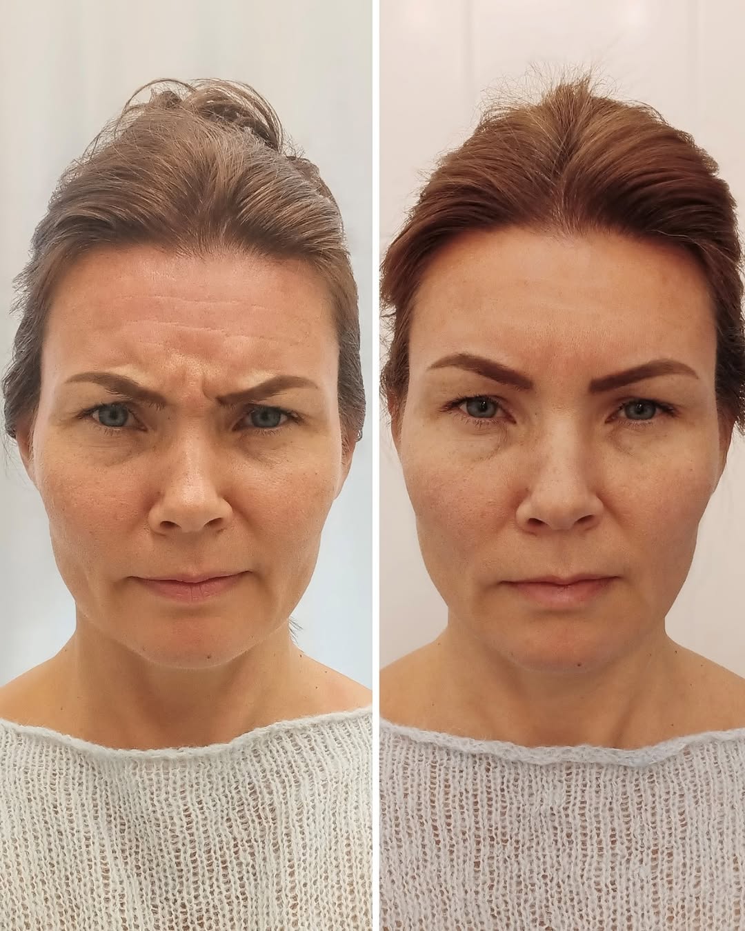 Sibeliusryppy botox ennen jälkeen hoitotulos