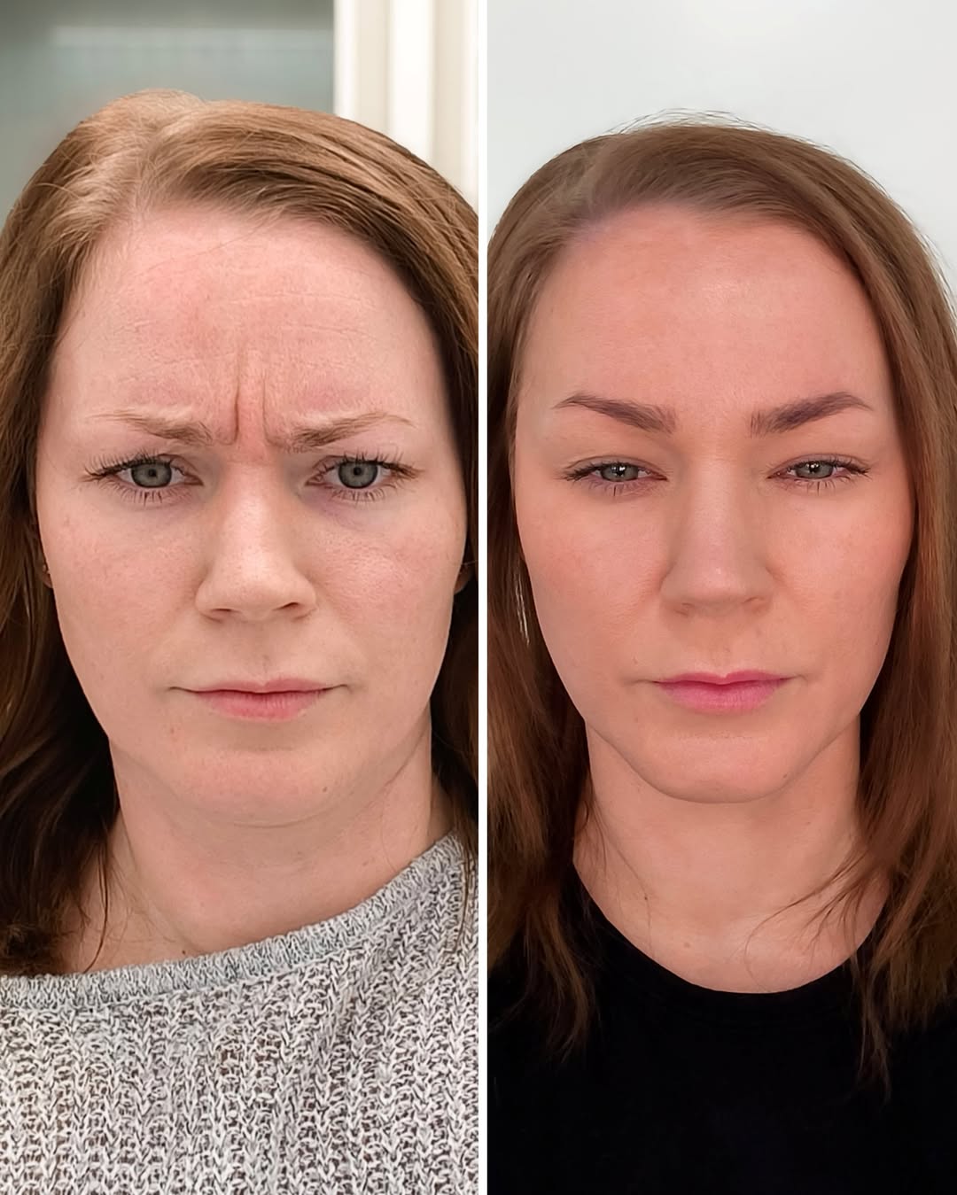 Botox sibeliusryppy ennen jälkeen – kulmien välin juonteiden hoito
