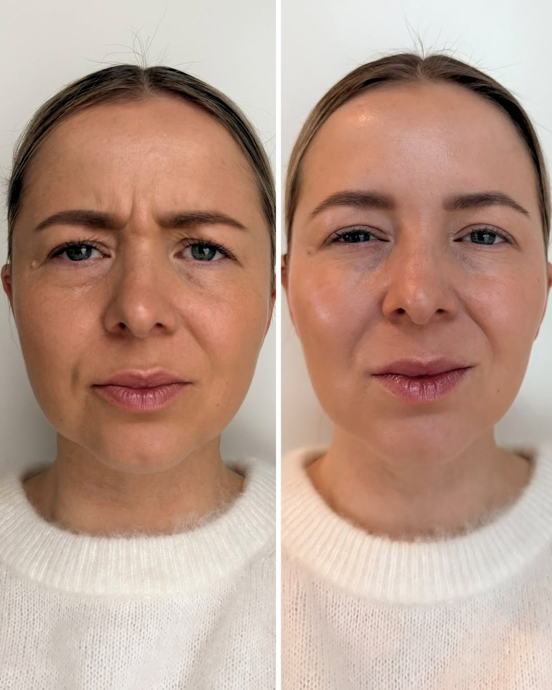 Sibeliusryppy botox ennen jälkeen