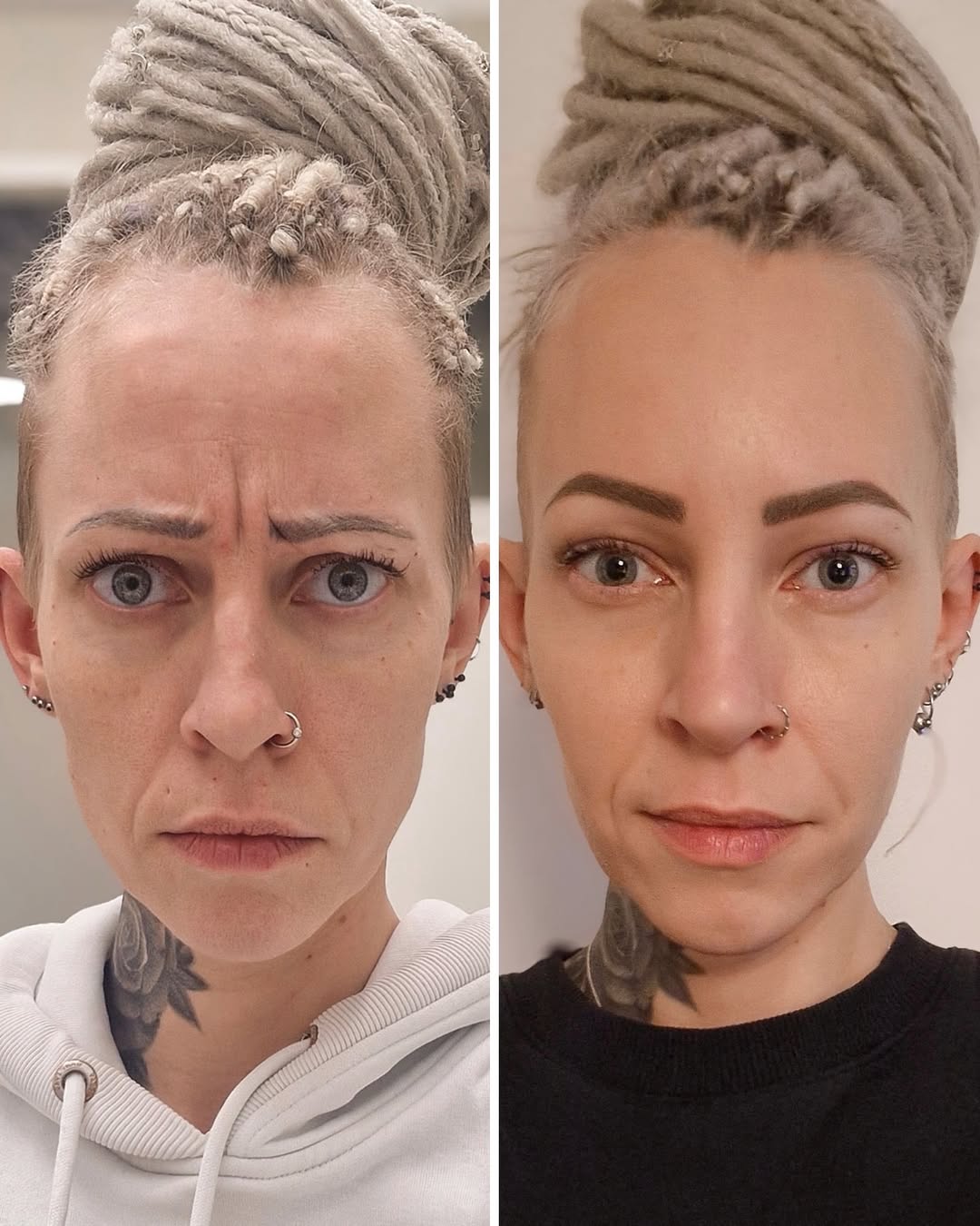 botox sibeliusryppy ennen jälkeen luonnollinen lopputulos