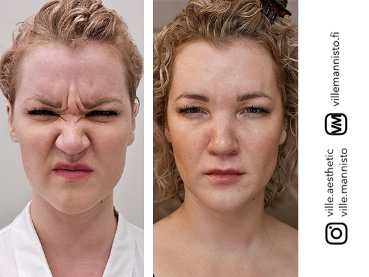 Sibelius wrinkles Botox before and after Tampere Ville Männistö botulinum treatment between the eyebrows