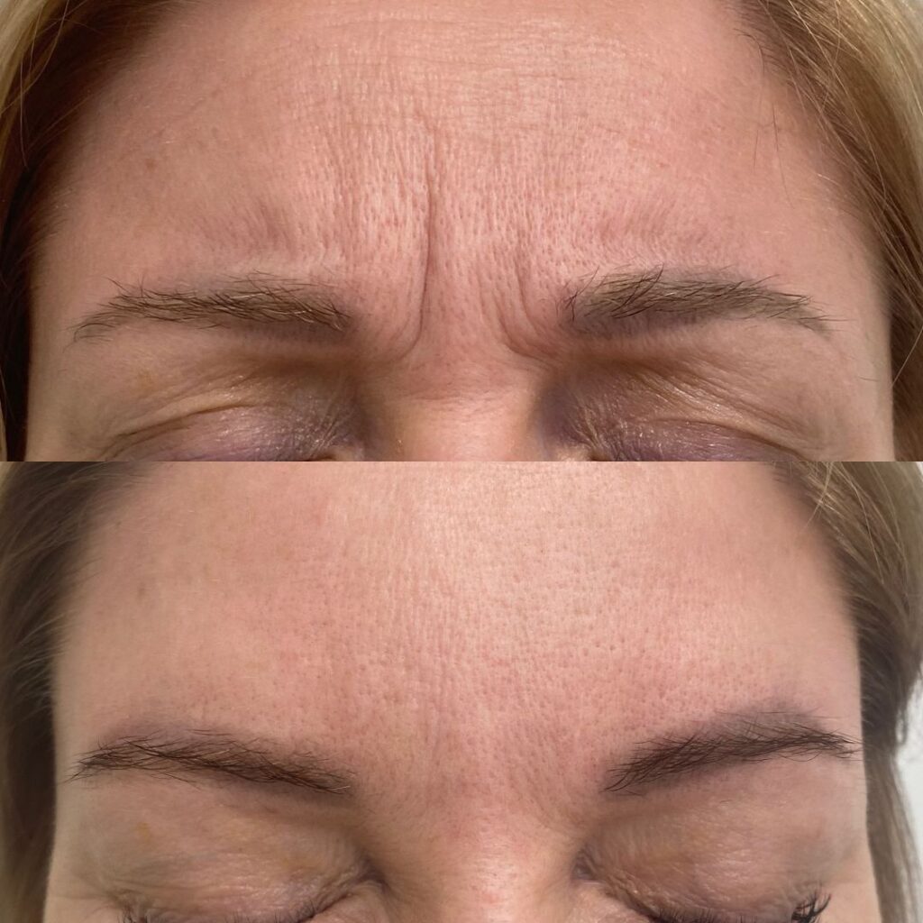 botox sibeliusryppy kokemuksia