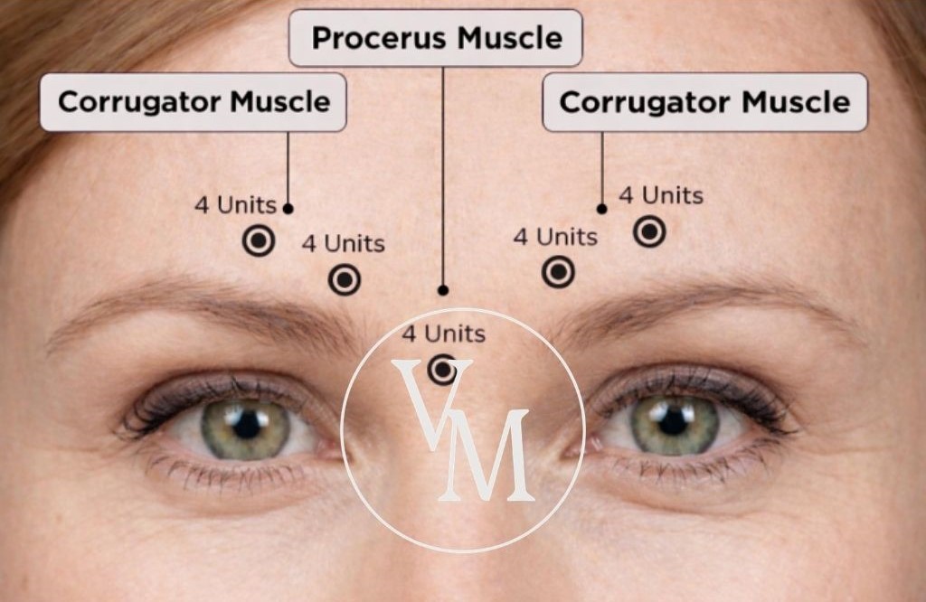 botox sibeliusryppy pistoskohdat corrugator procerus
