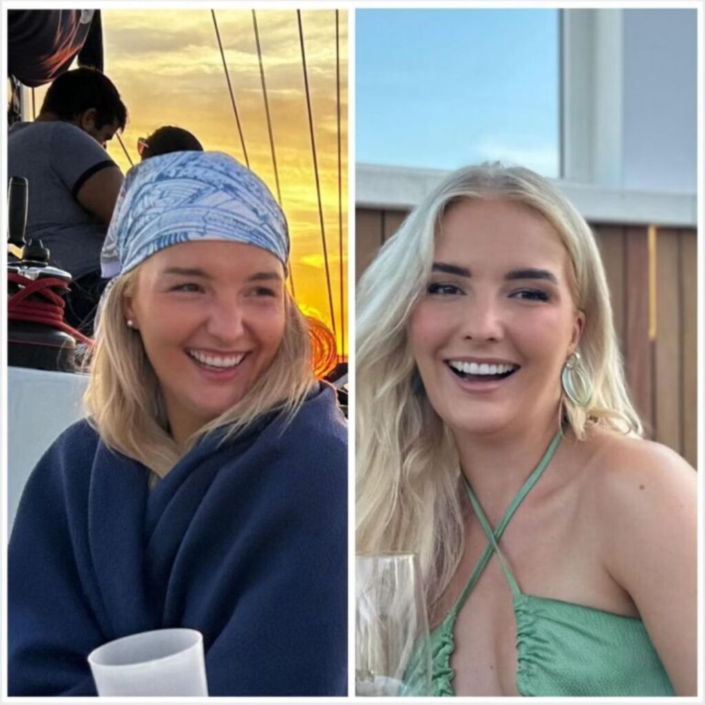 botox huulet helsinki ennen jälkeen gummy smile ienhymy