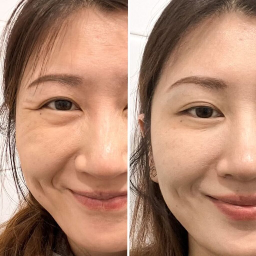 harakanvarpaat botox helsinki ja pori ennen jälkeen