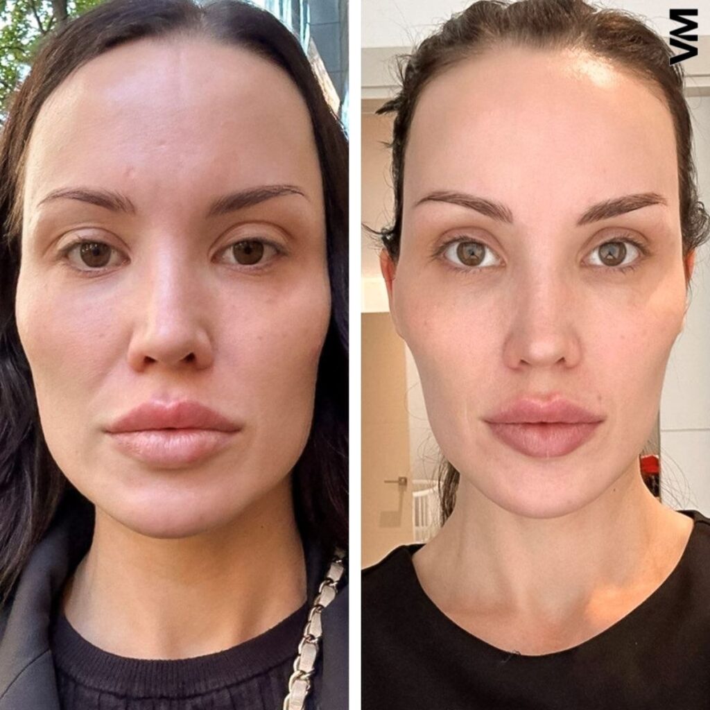 Masseter Botox price