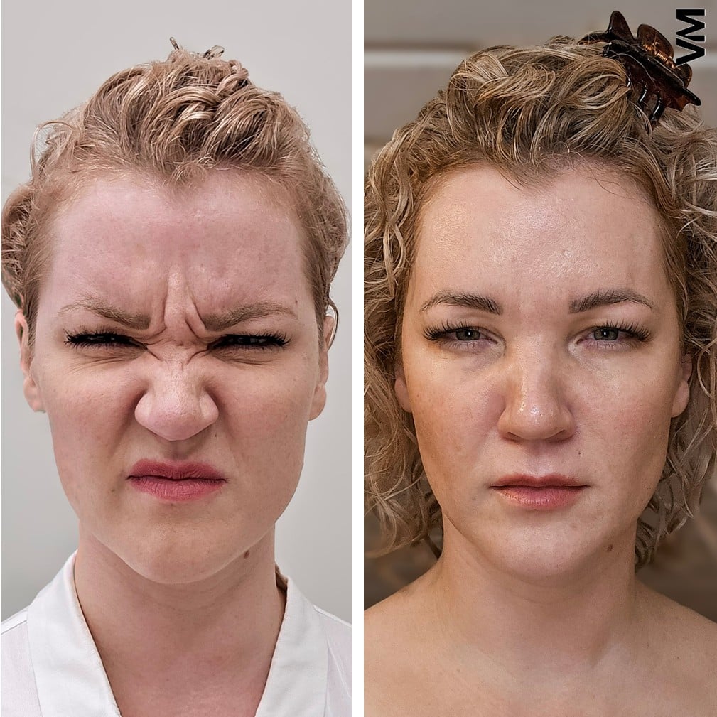 sibeliusryppy botox ennen jälkeen Tampere Ville Männistö luonnollinen hoitotulos