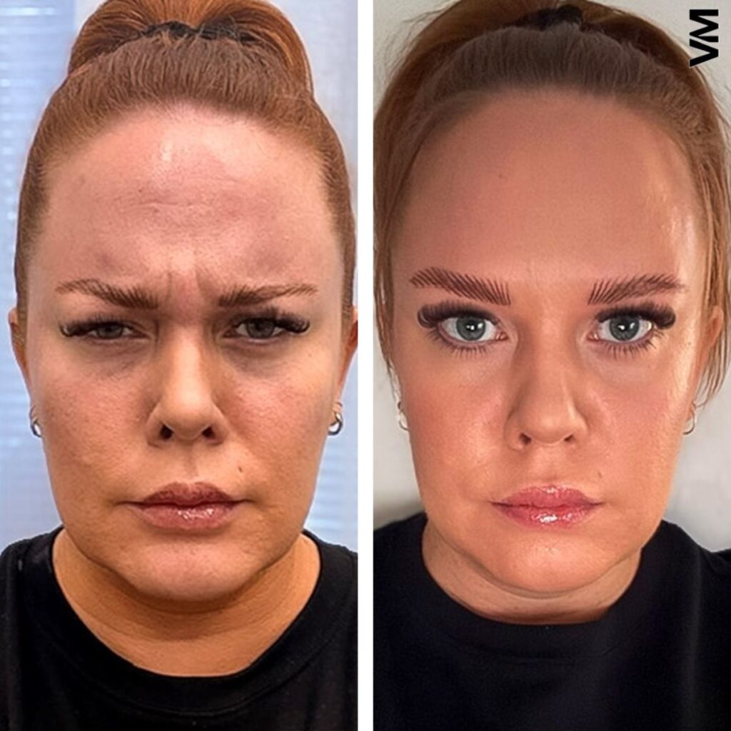 sibeliusryppy botox helsinki ennen jälkeen botuliinihoito pori