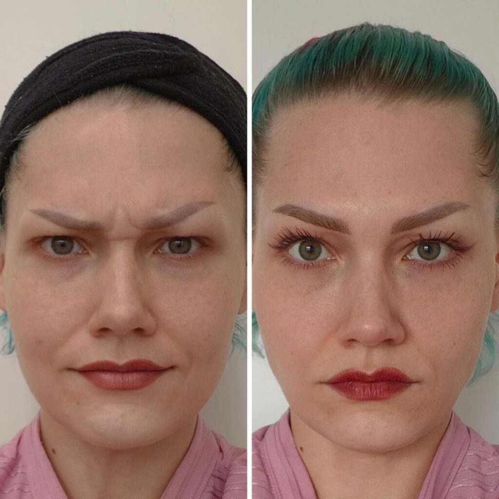 sibeliusryppy botox helsinki ennen jalkeen botox pori