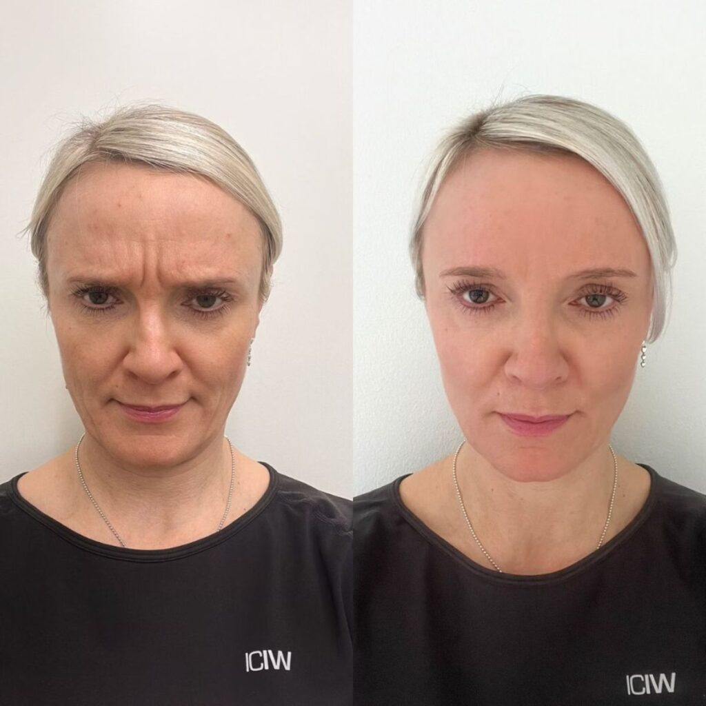 sibeliusryppy botox helsinki ennen jalkeen botox pori