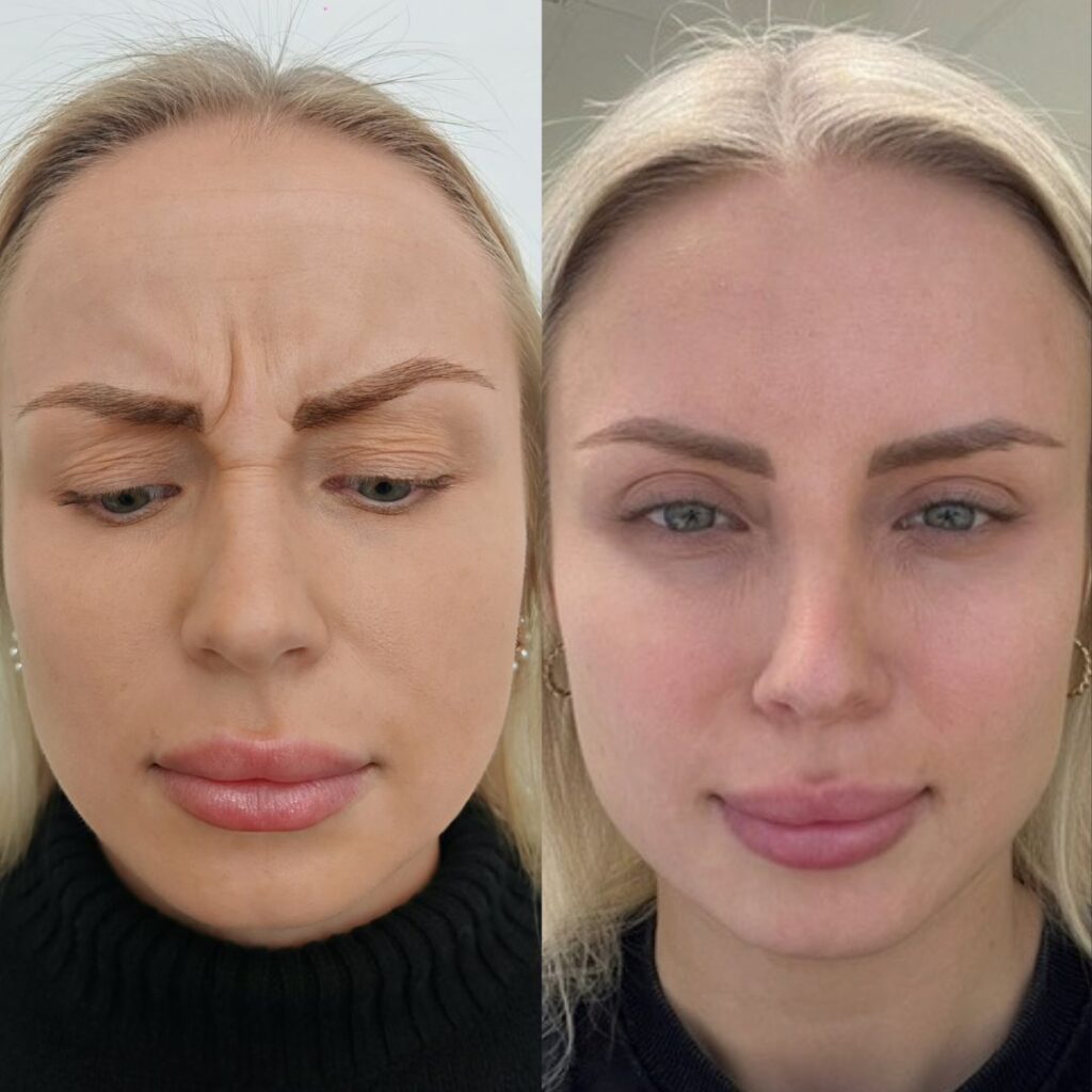 sibeliusryppy botox hinta 289 €