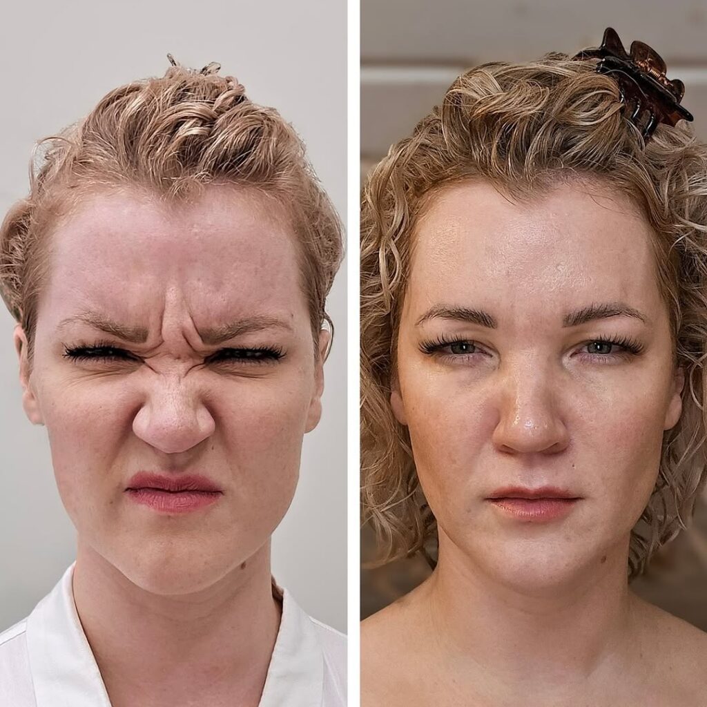 Sibelius wrinkle Botox price